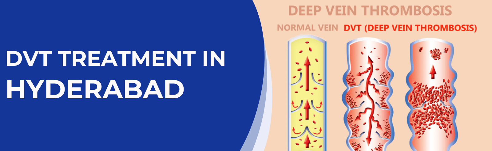 DVT Treatment in Hyderabad